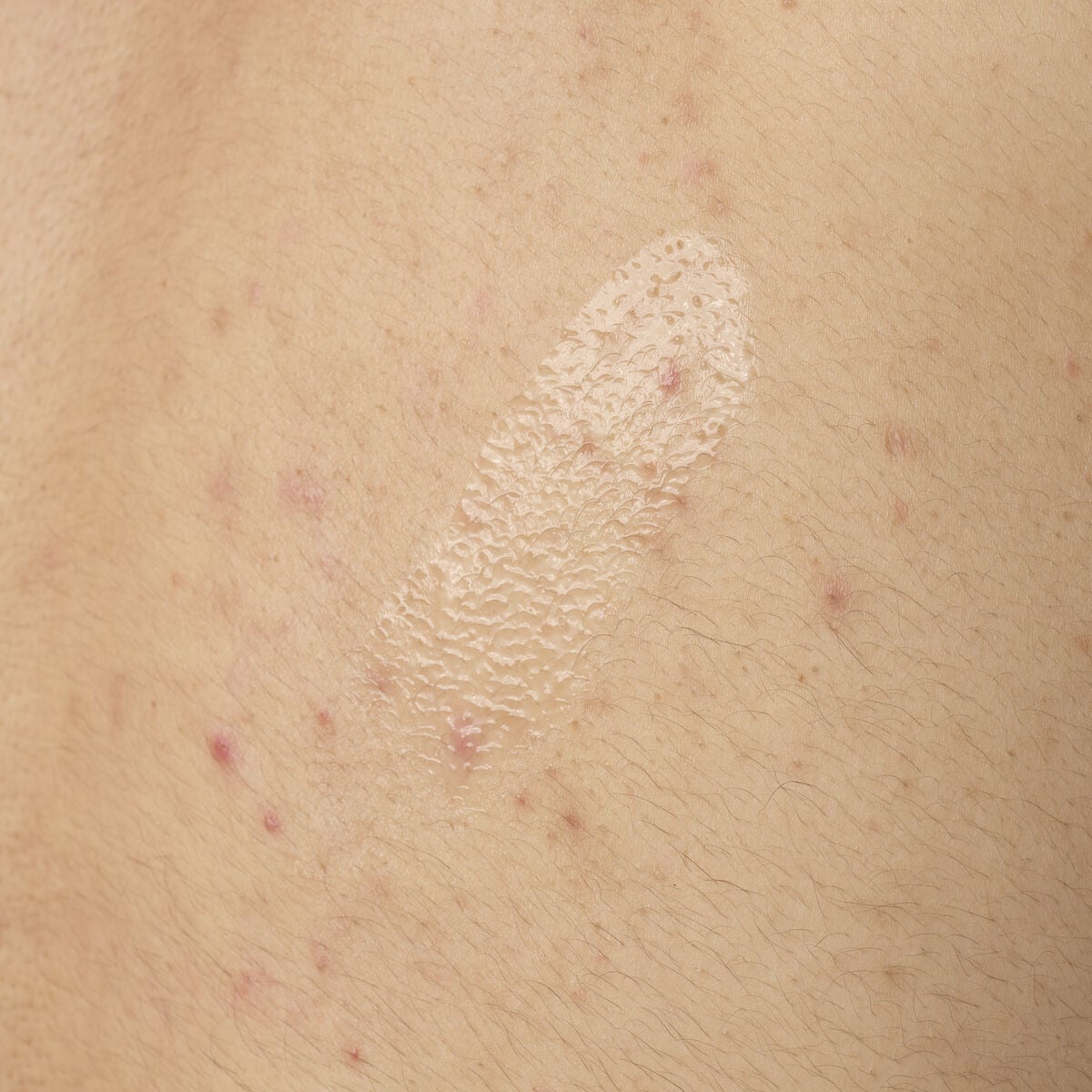 salicylic-acid-0-5-body-serum-a5 ORD-salicylic-acid-05-body-240ml-application.jpg